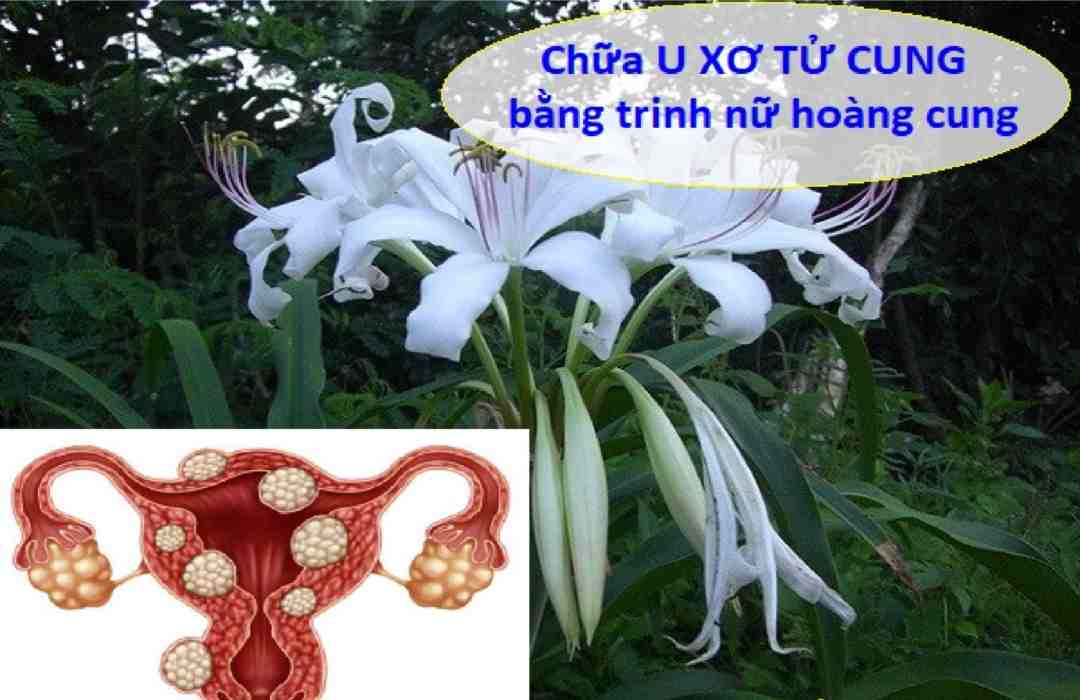 Loài cây giúp chữa u xơ tử cung và các bệnh phụ khoa hiệu quả